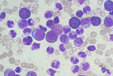 New Indication Granted for Bosutinib to Treat Newly Diagnosed Ph+ CML