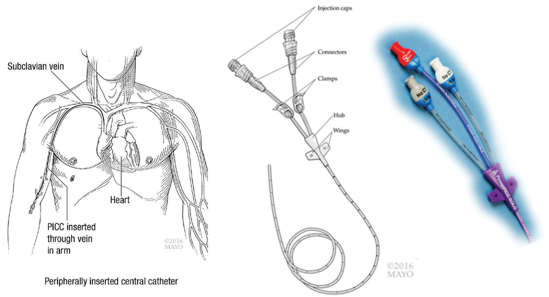 Cateter Groshong Vs Linha Picc Indwelling Vascular Devices Emergency