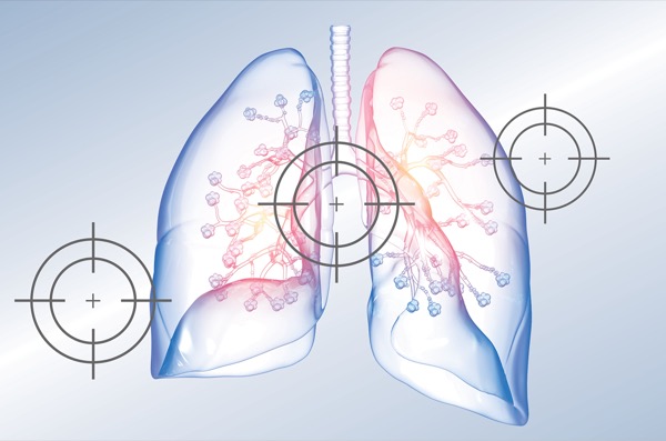 Biologics Hit Multiple Targets in Asthma and COPD